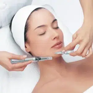 microneedling procedure