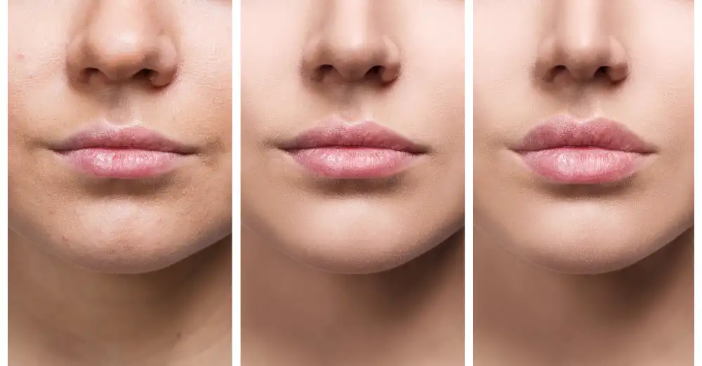 Dermal Filler Treatments near Frisco